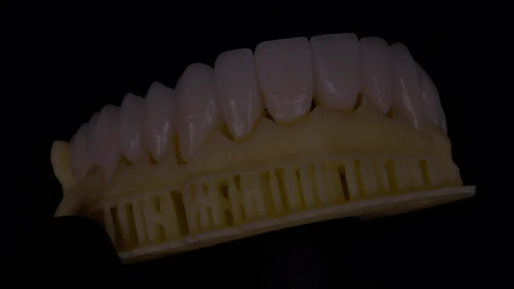 Lentes de Contato Dental: Transformando Seu Sorriso com Elegância